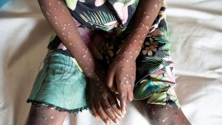mpox