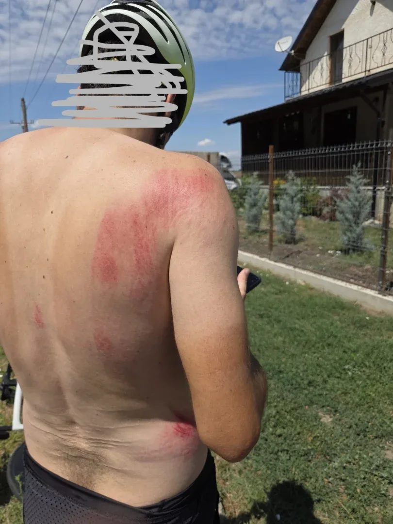 Foto - leziunile unuia dintre bicicliștii atacați de pitbull foto - leziunile unuia dintre bicicliștii atacați de pitbull